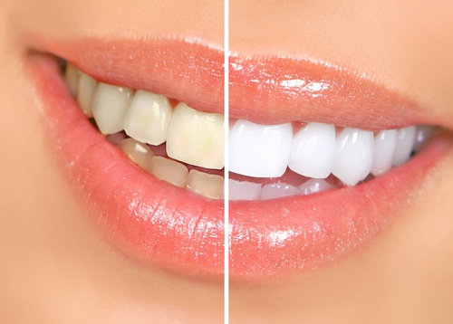 theeth whitening before and after