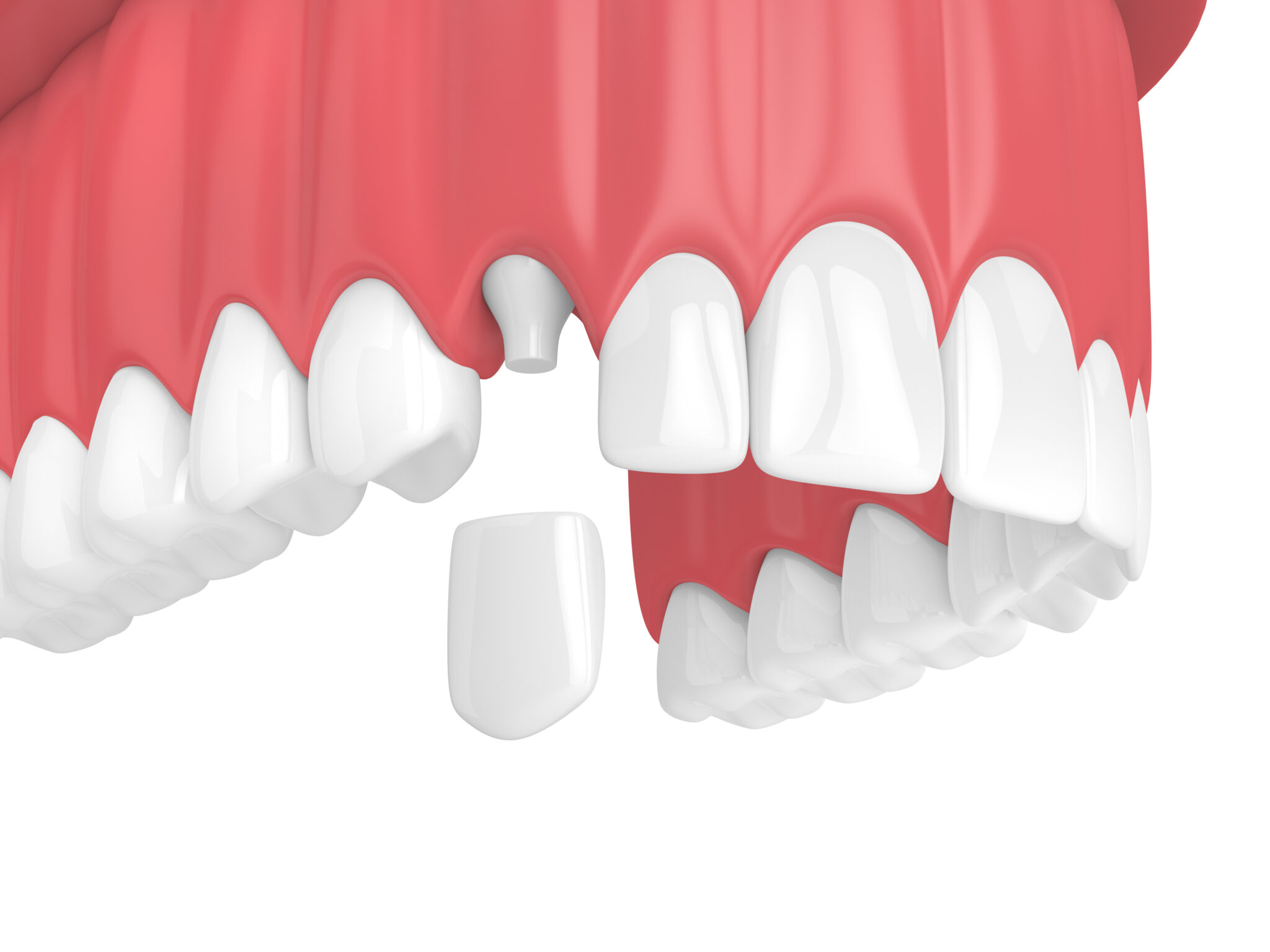sheridan dental crowns
