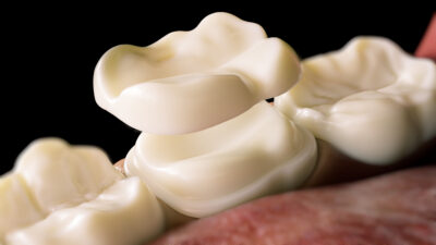 sheridan cerec crowns