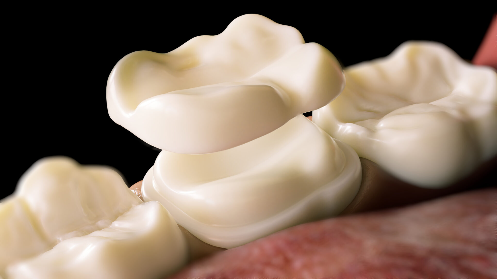 sheridan cerec crowns