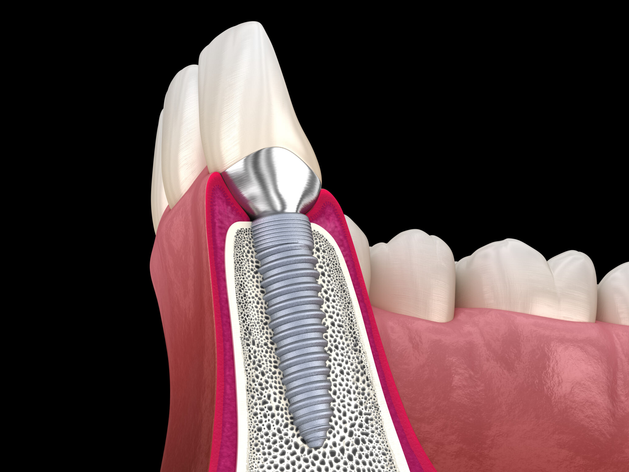 sheridan dental implants