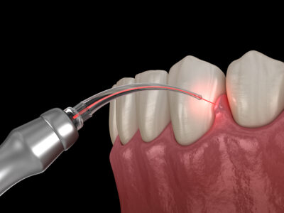 sheridan dental lasers