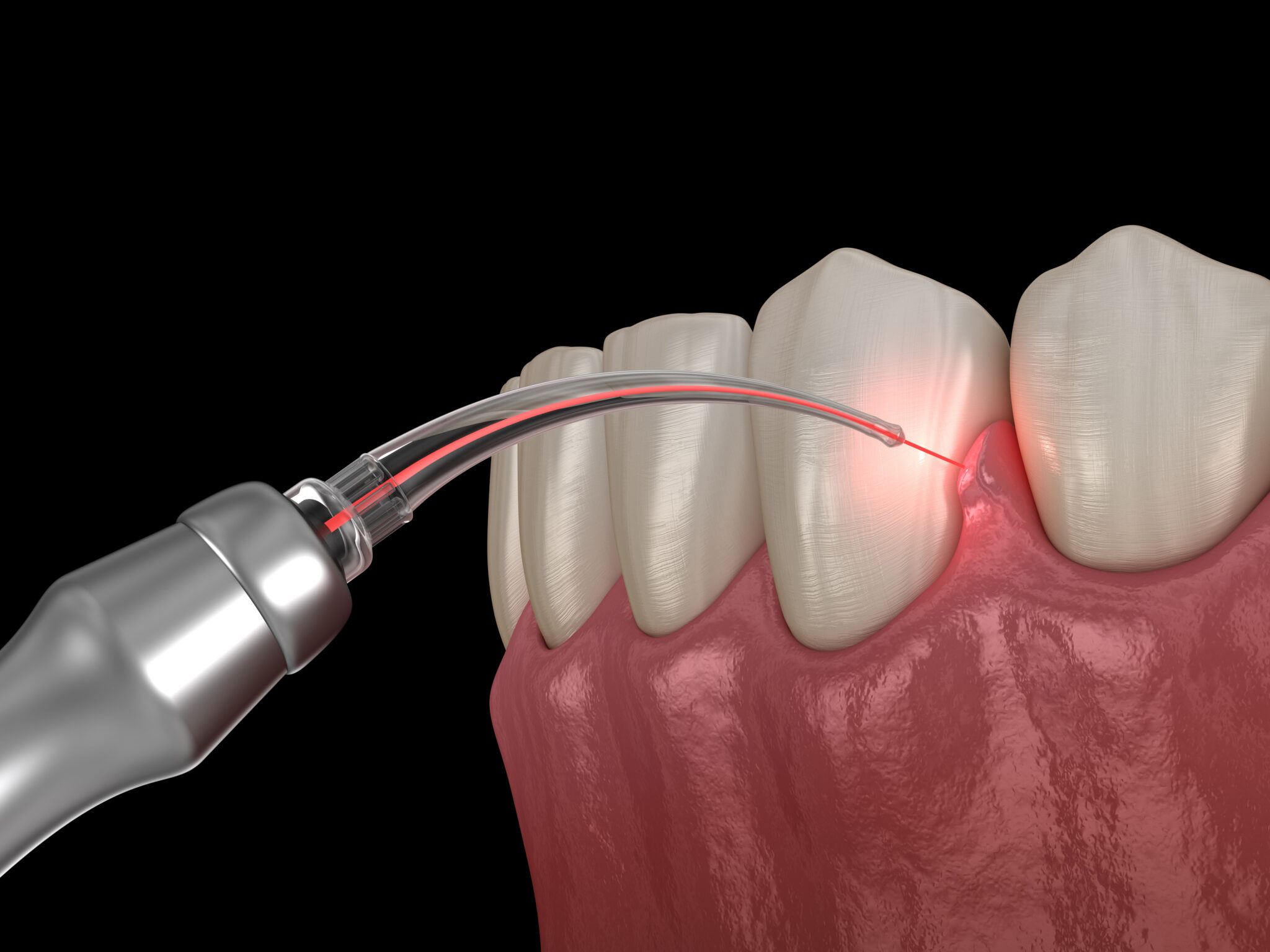 sheridan dental lasers