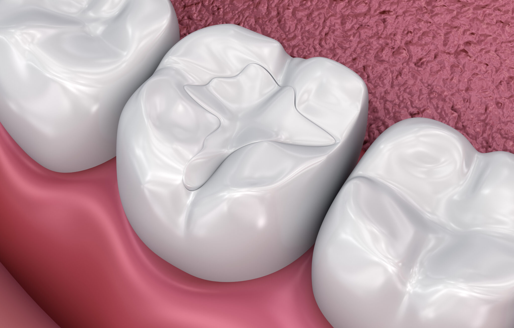 sheridan dental fillings
