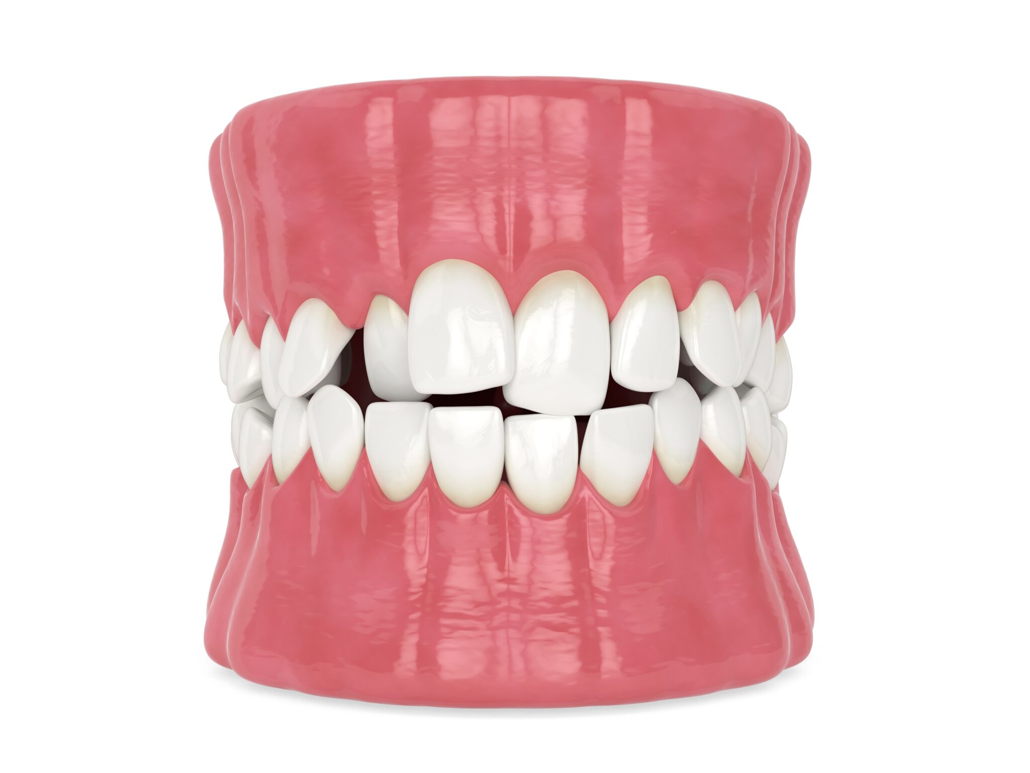 grinnell malocclusion