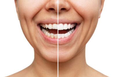 sheridan veneers
