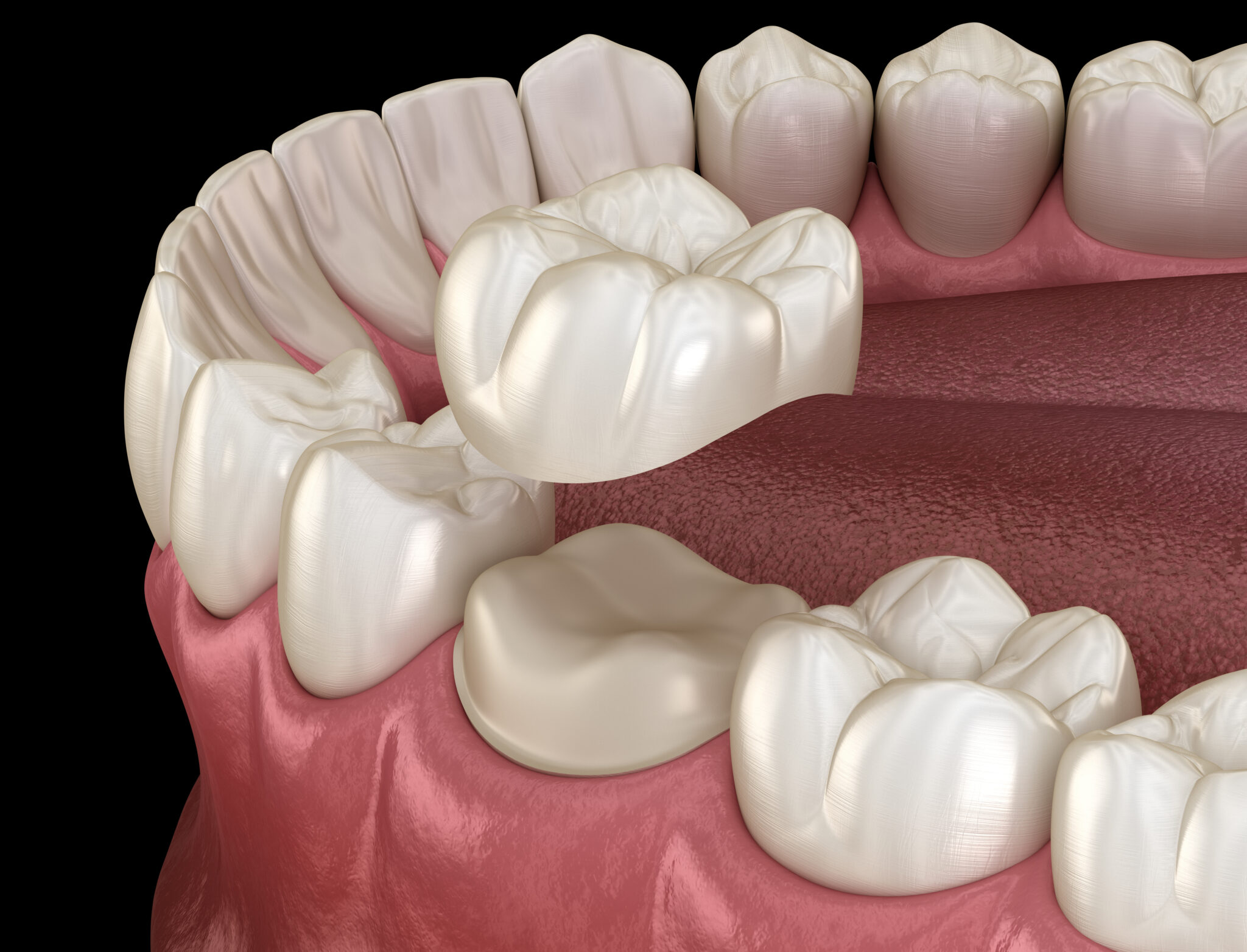 sheridan dental crowns