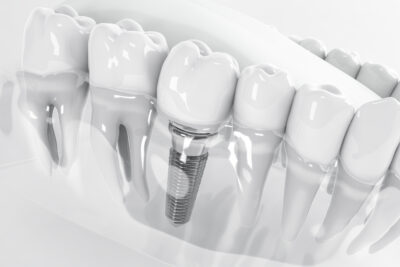 sheridan dental implants