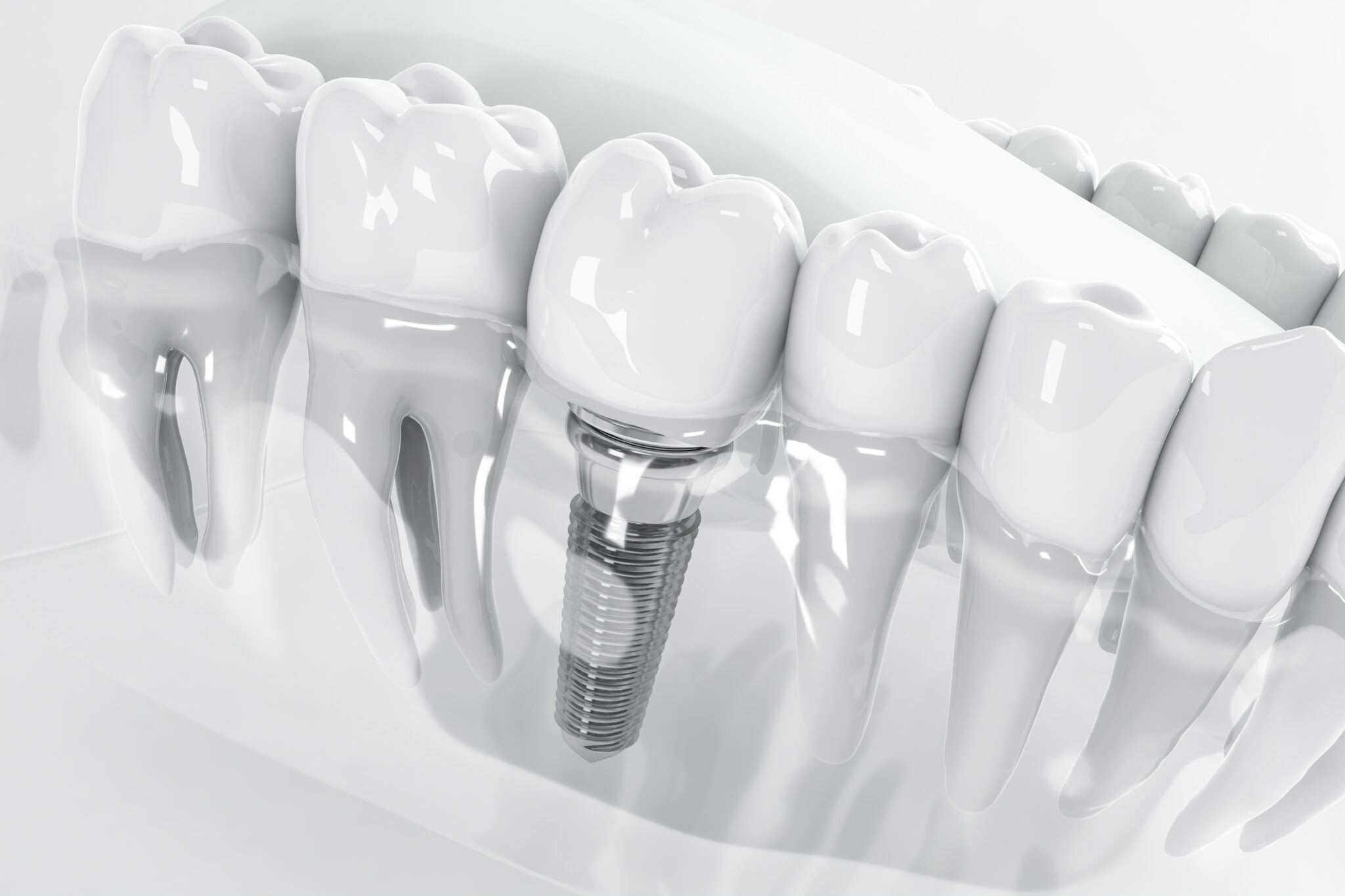 sheridan dental implants