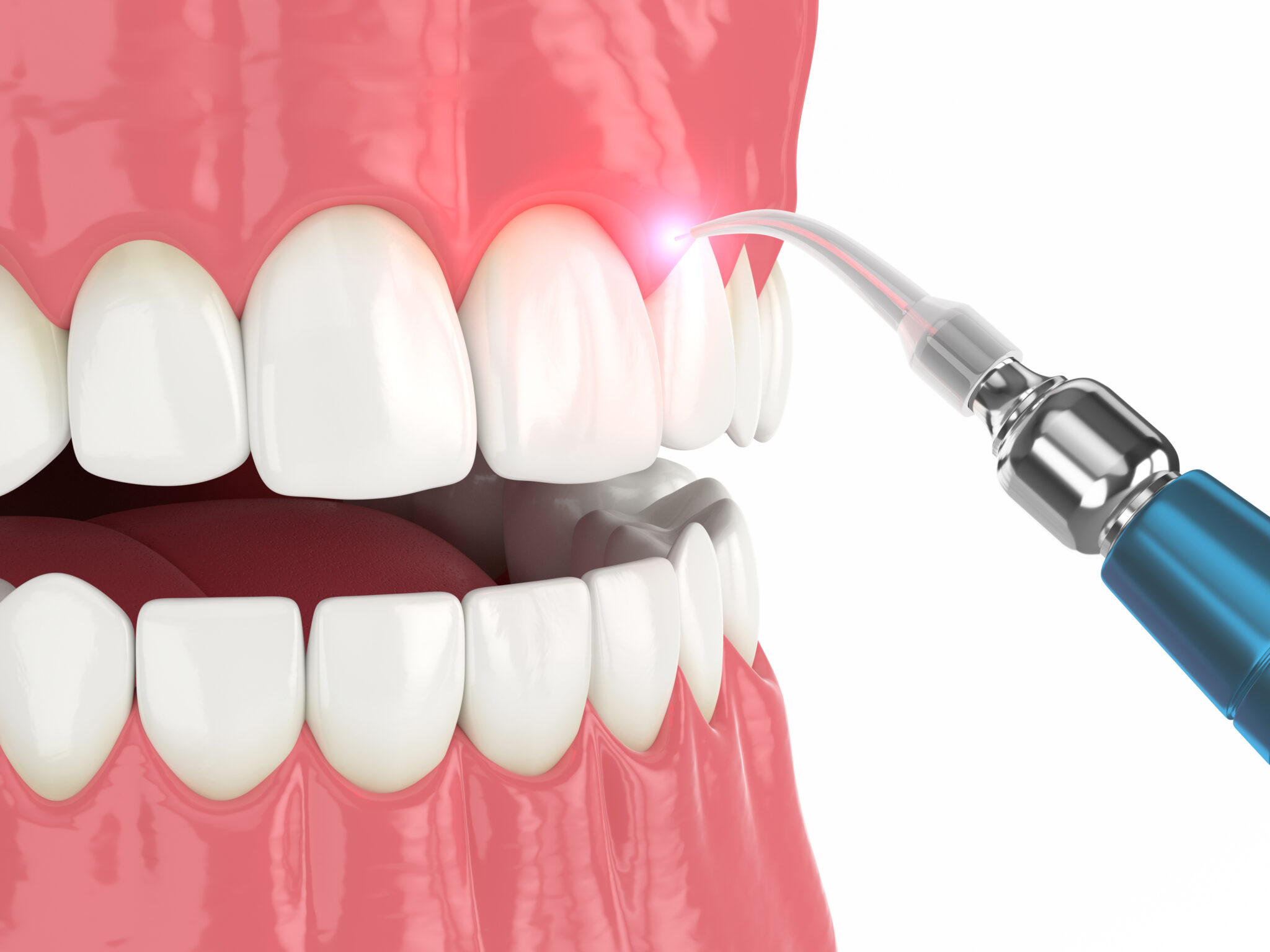 sheridan laser dentistry