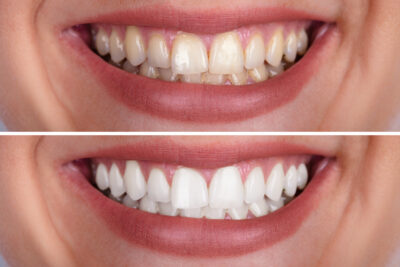 sheridan teeth whitening