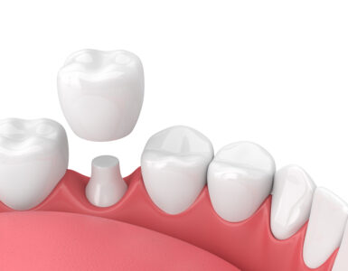 dental crown