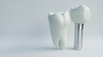 dental implant