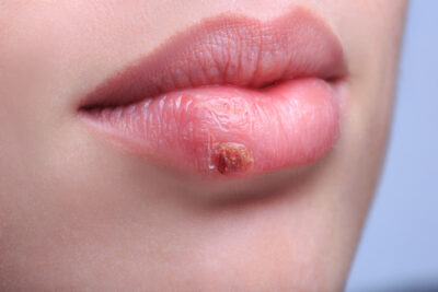 Grinnell Street dental can help treat your cold sores