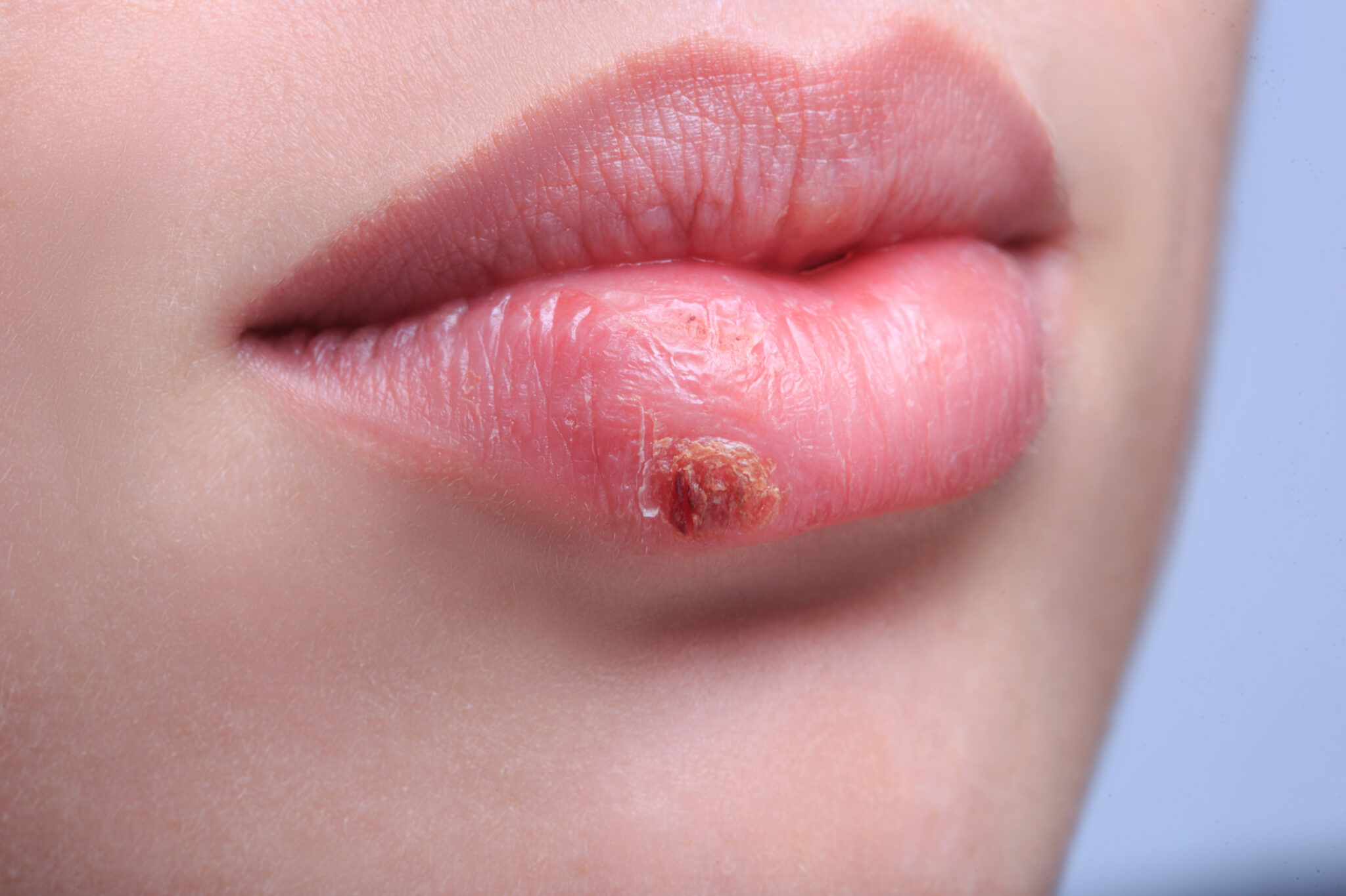 Grinnell Street dental can help treat your cold sores