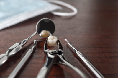 tooth extraction
