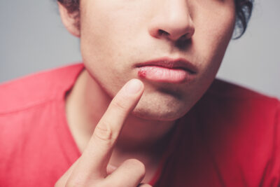 Sheridan, WY, dentist offers treatment for cold sores