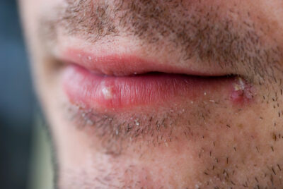 Sheridan, WY, dentist offers laser treatment for cold sores