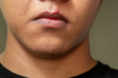 Sheridan, WY, dentist offers treatments for cold sores