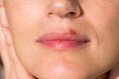 Sheridan, WY, dentist offers treatment for cold sores 