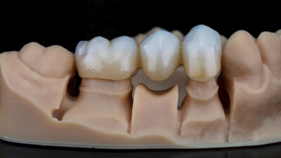 Sheridan, WY, dentist offers crowns and bridges