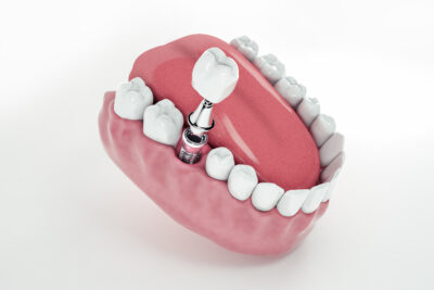 Sheridan, WY, dentist offers dental implants for patients
