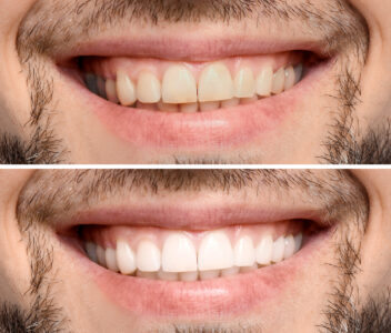Sheridan, WY, dentist offers teeth whitening