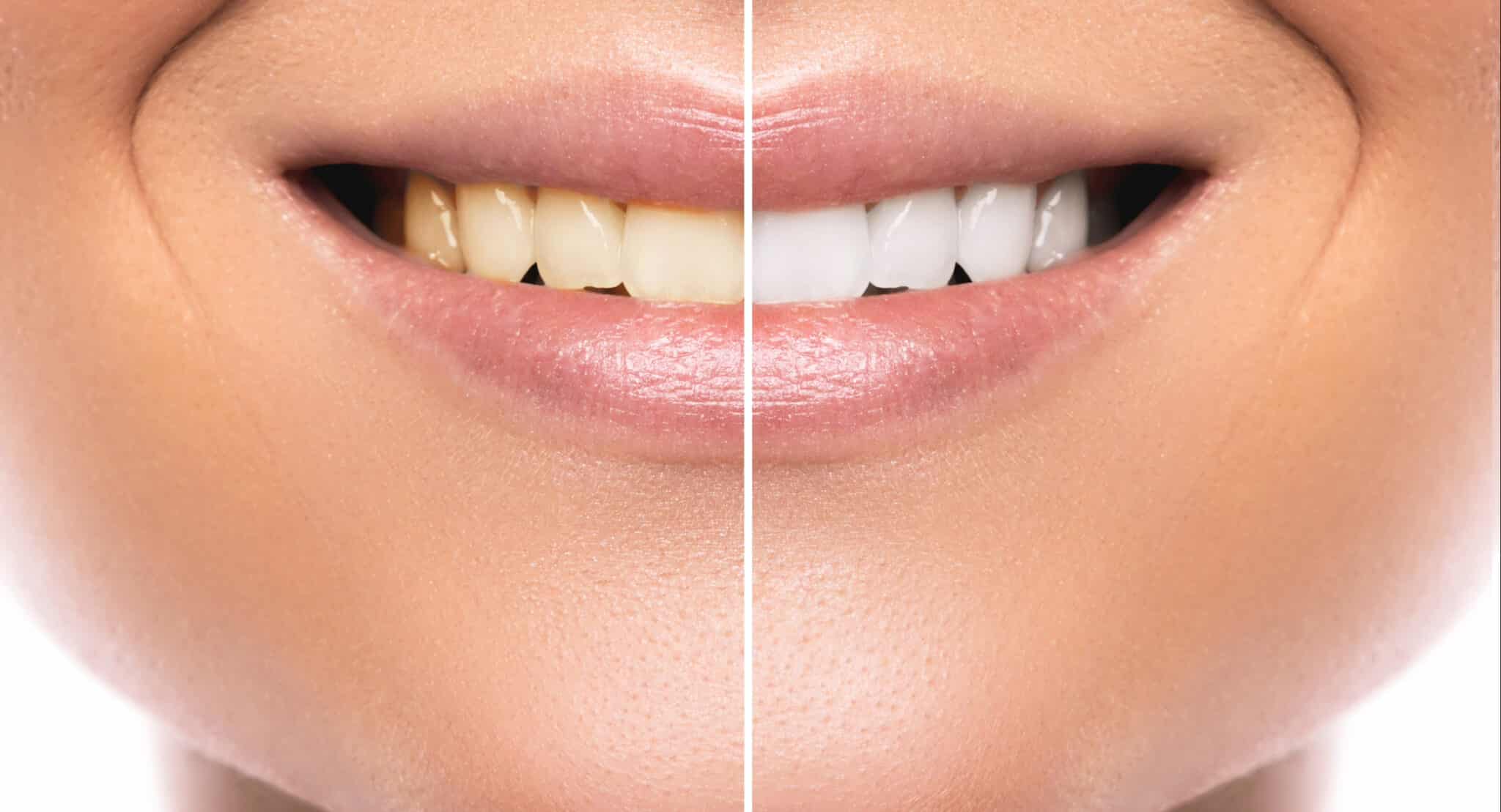 sheridan teeth whitening