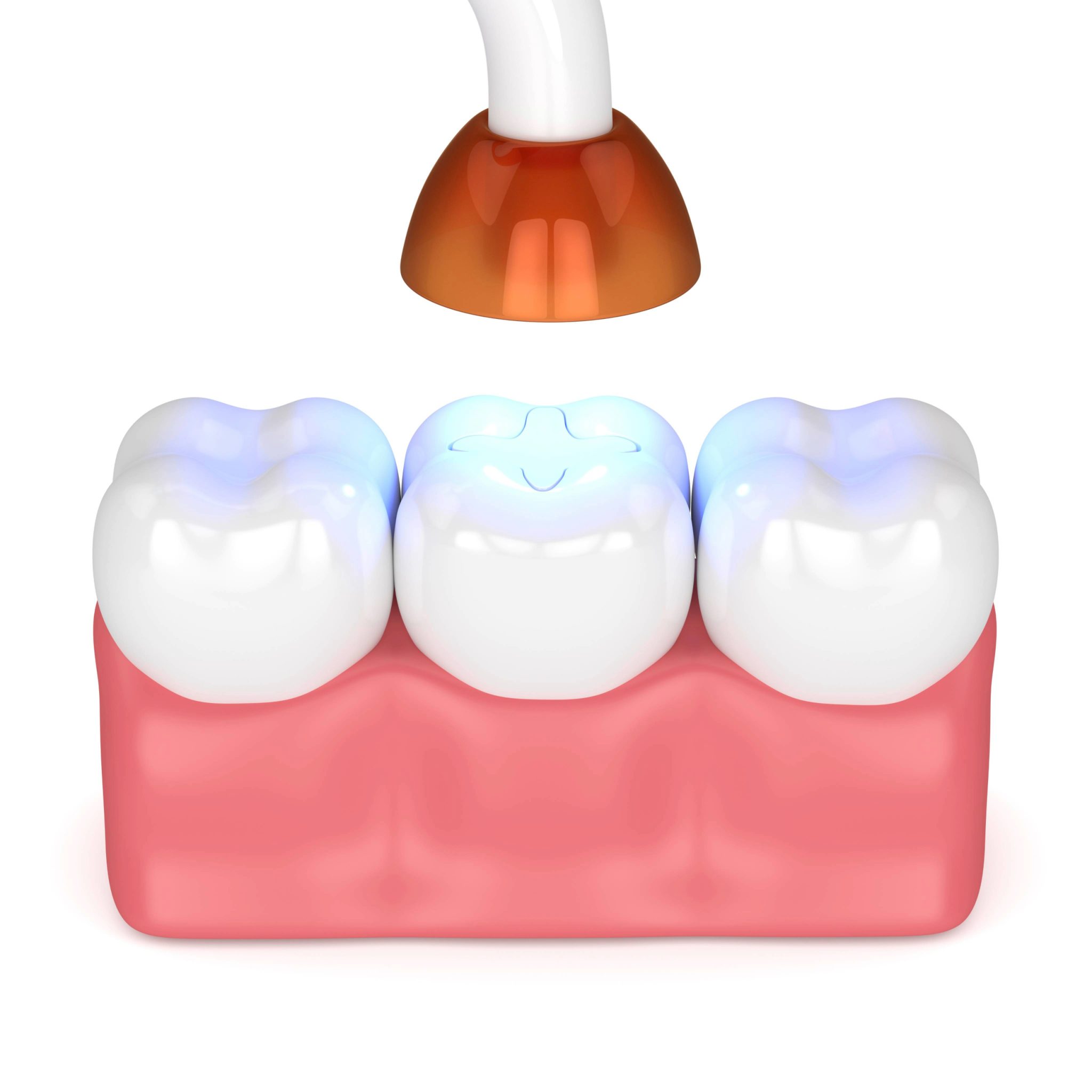 sheridan dental filling